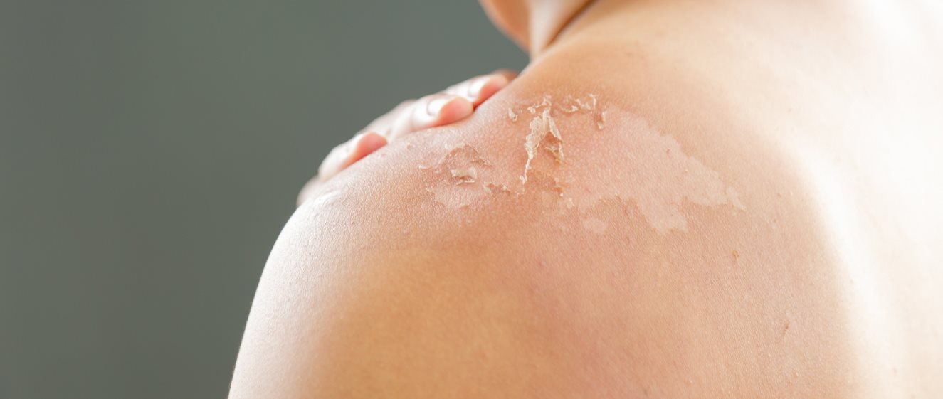 Es Reibt Sich Die Haut Mit Der Lotion Ein Haut schält sich – was hilft?